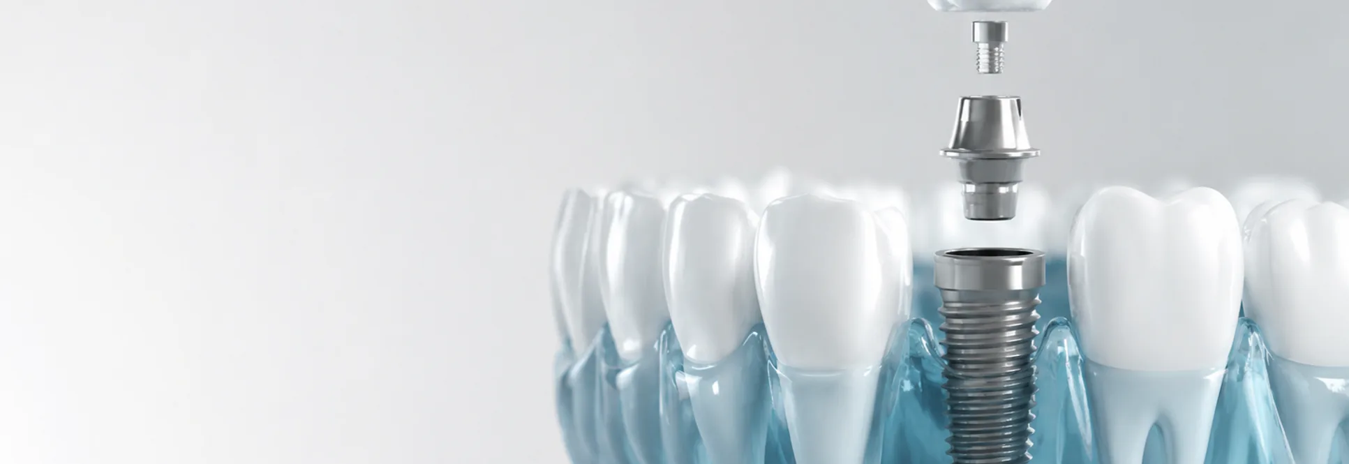 Computer guided dental implants at Broadview Dental Clinic